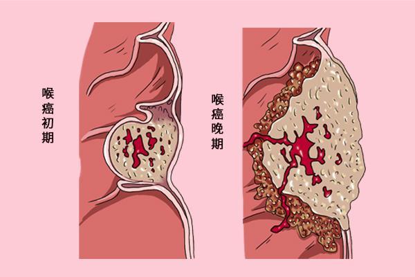 喉咙肿痛引发呼吸困难的紧急救援指南